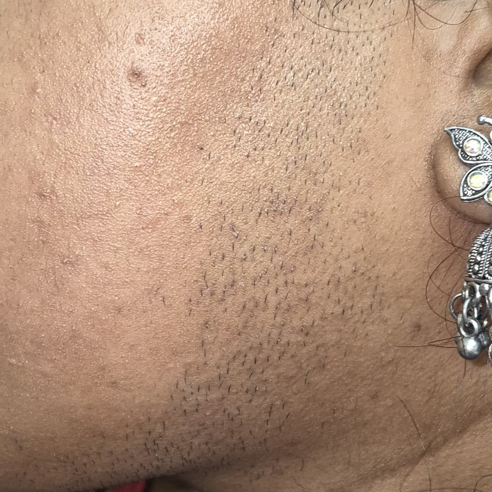 Laser Hair Removal Before