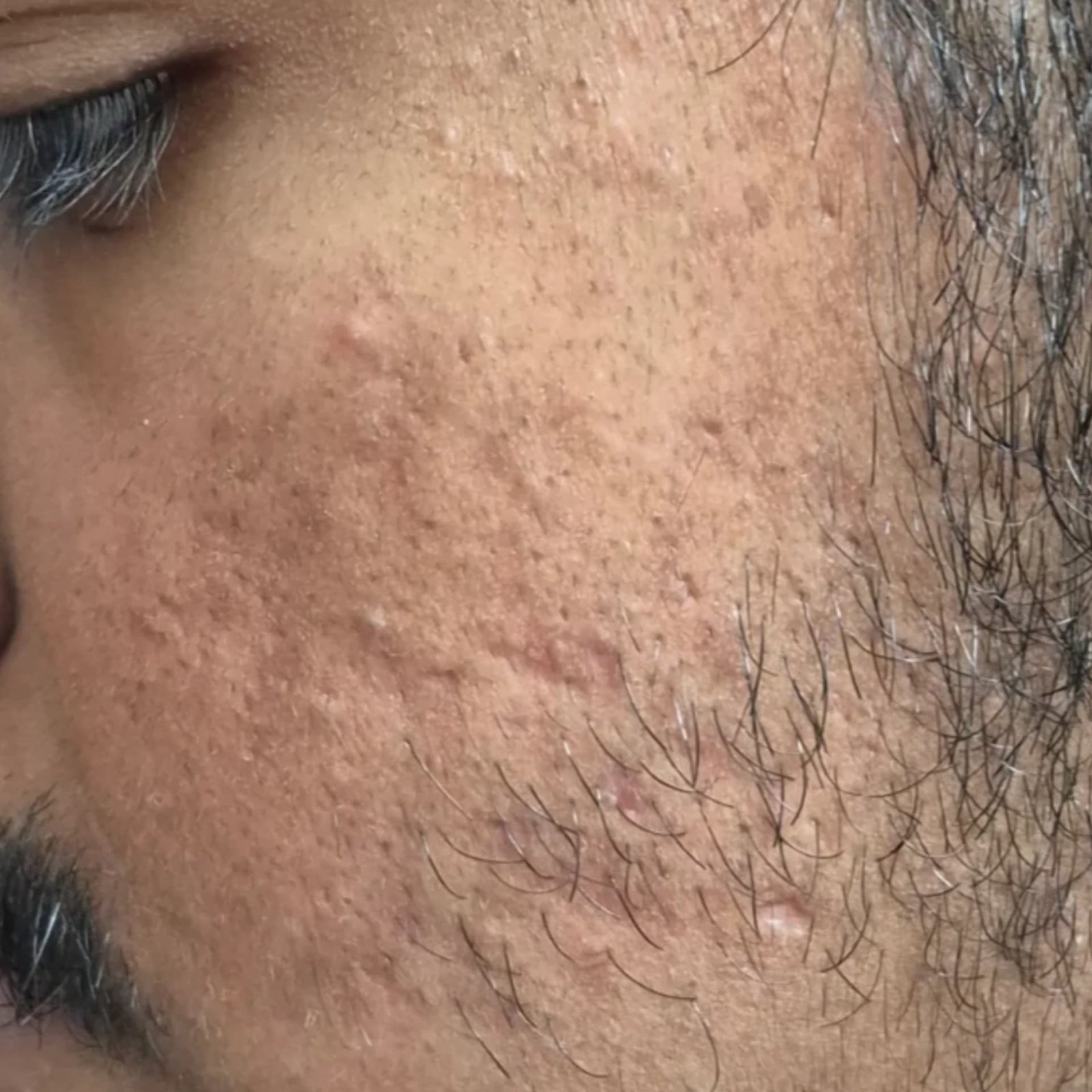 Acne Scar Patient 4 Before