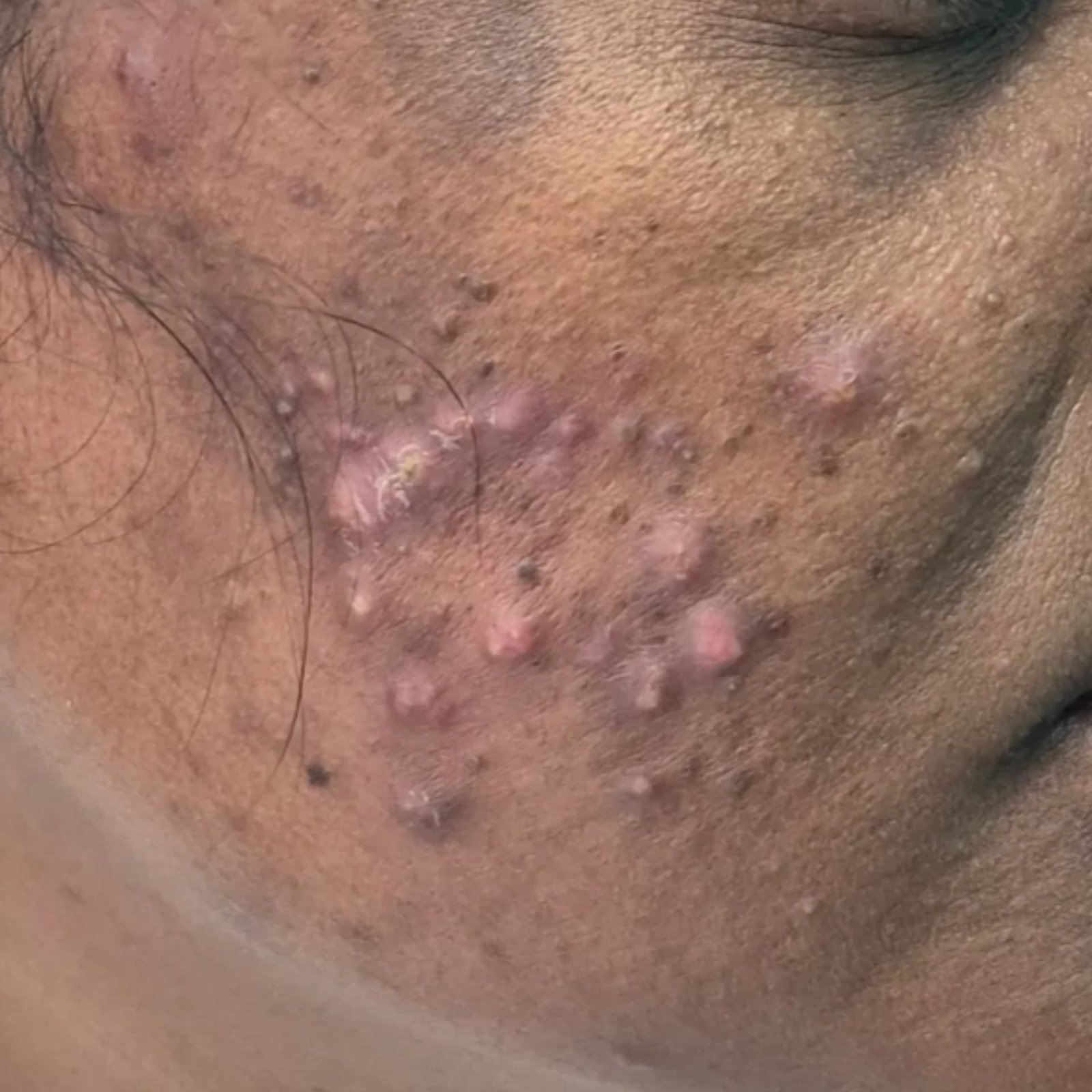Acne Scar Treatment Before