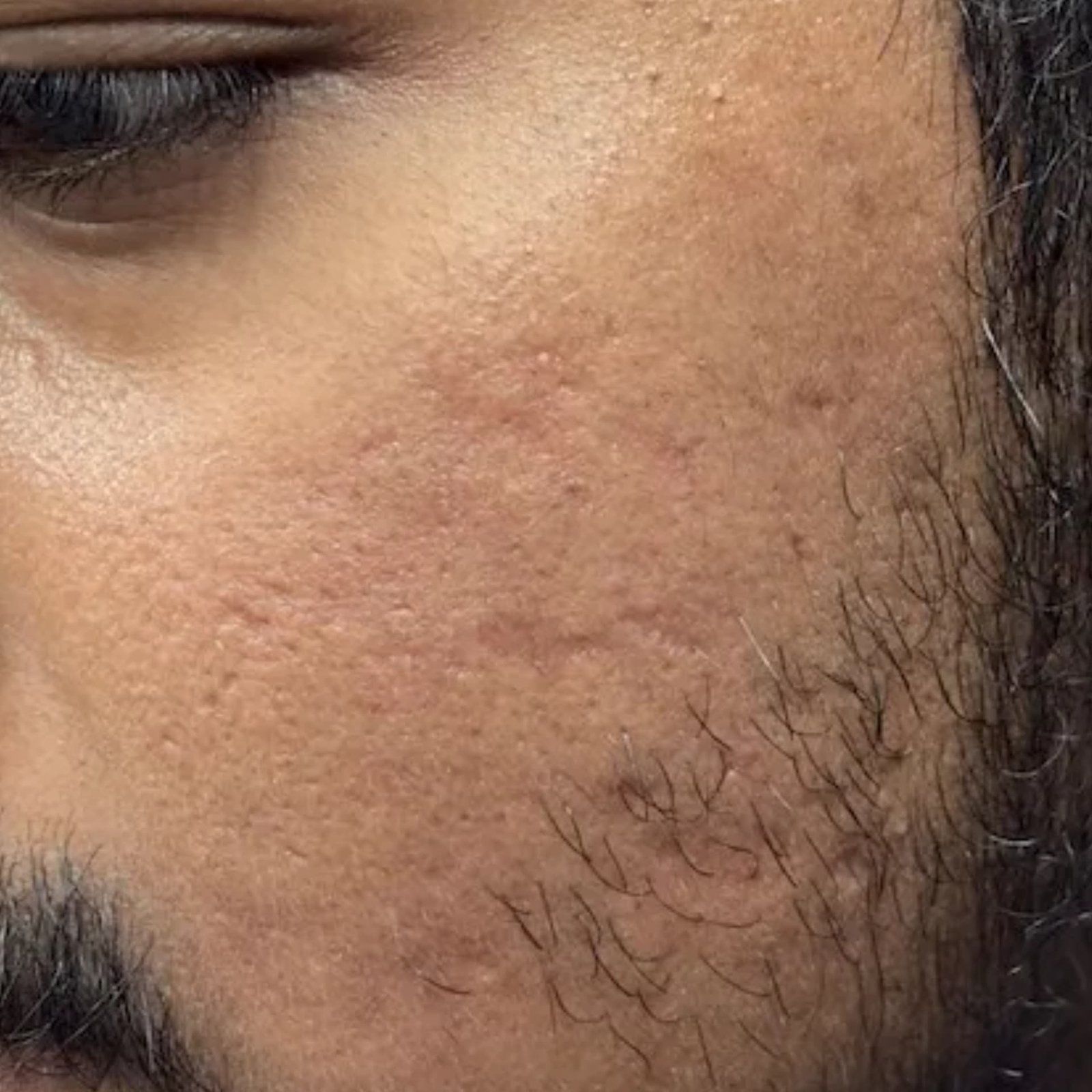 Acne Scar Patient 4 After