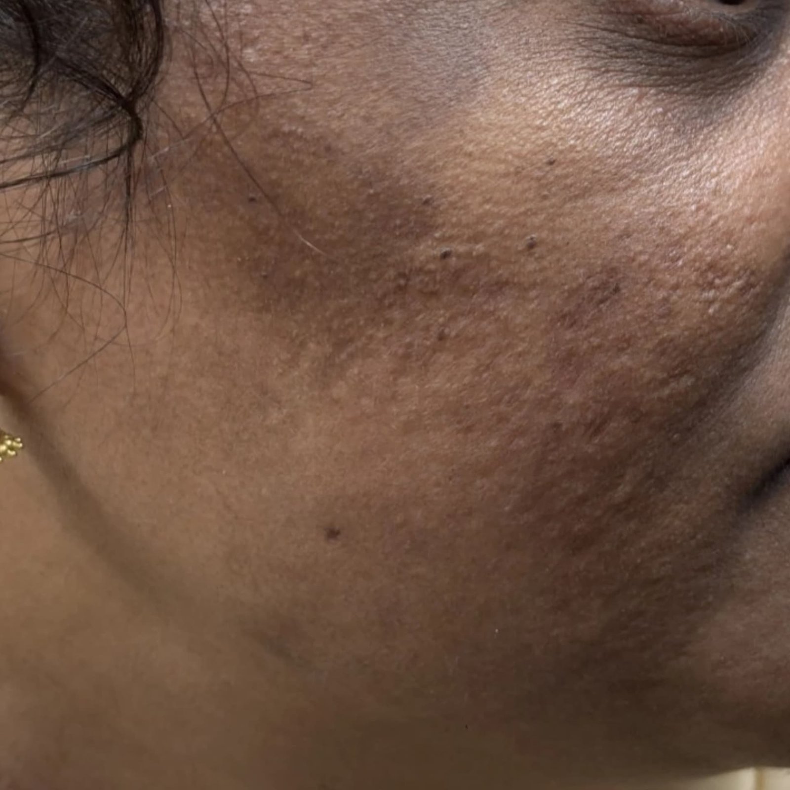 Acne Scar Treatment After