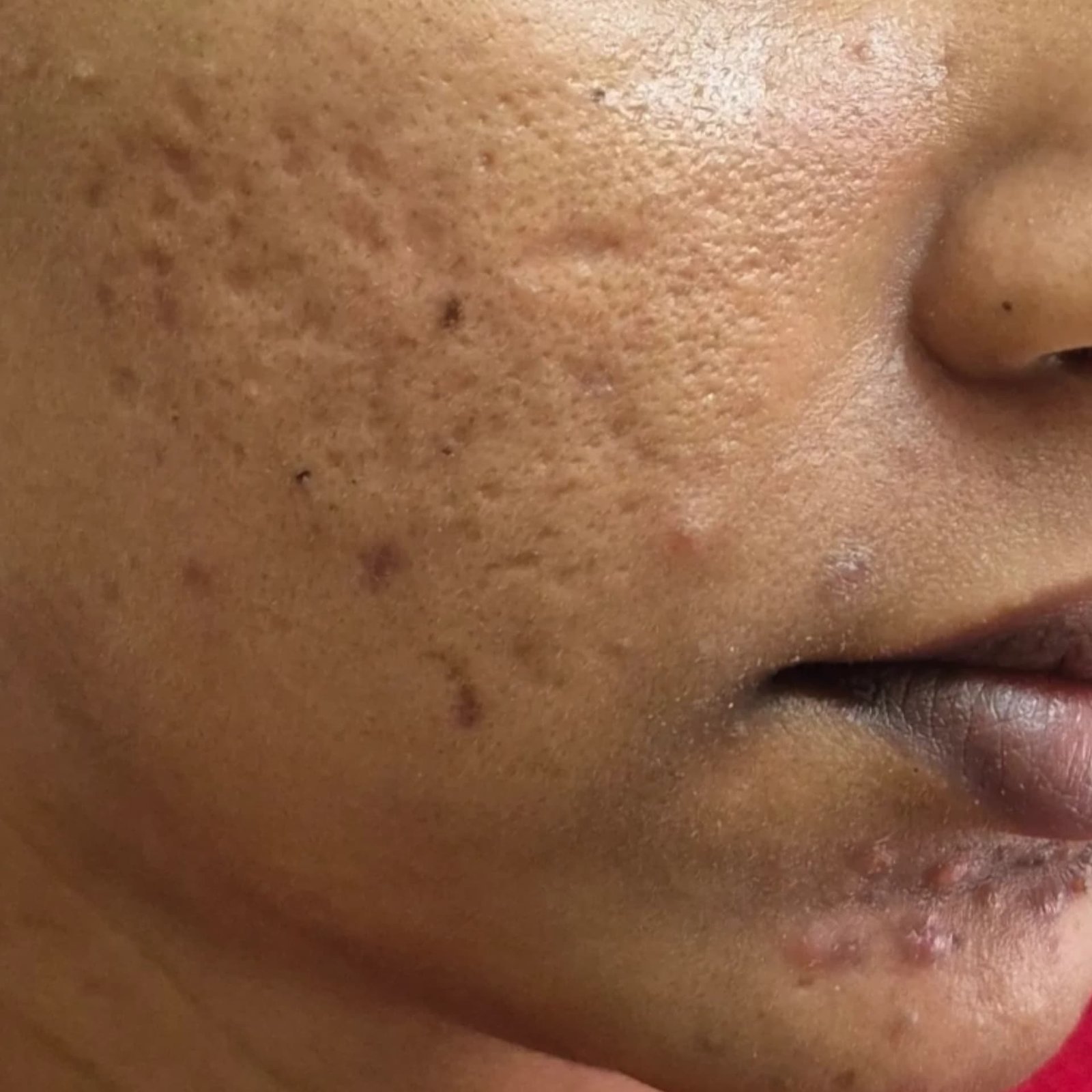 Acne Scar Patient 5 Before