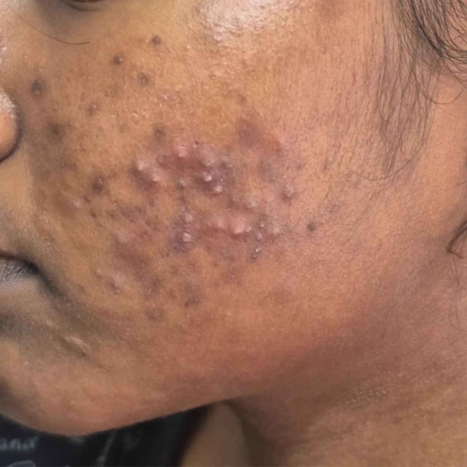 Active Acne Treatment Before