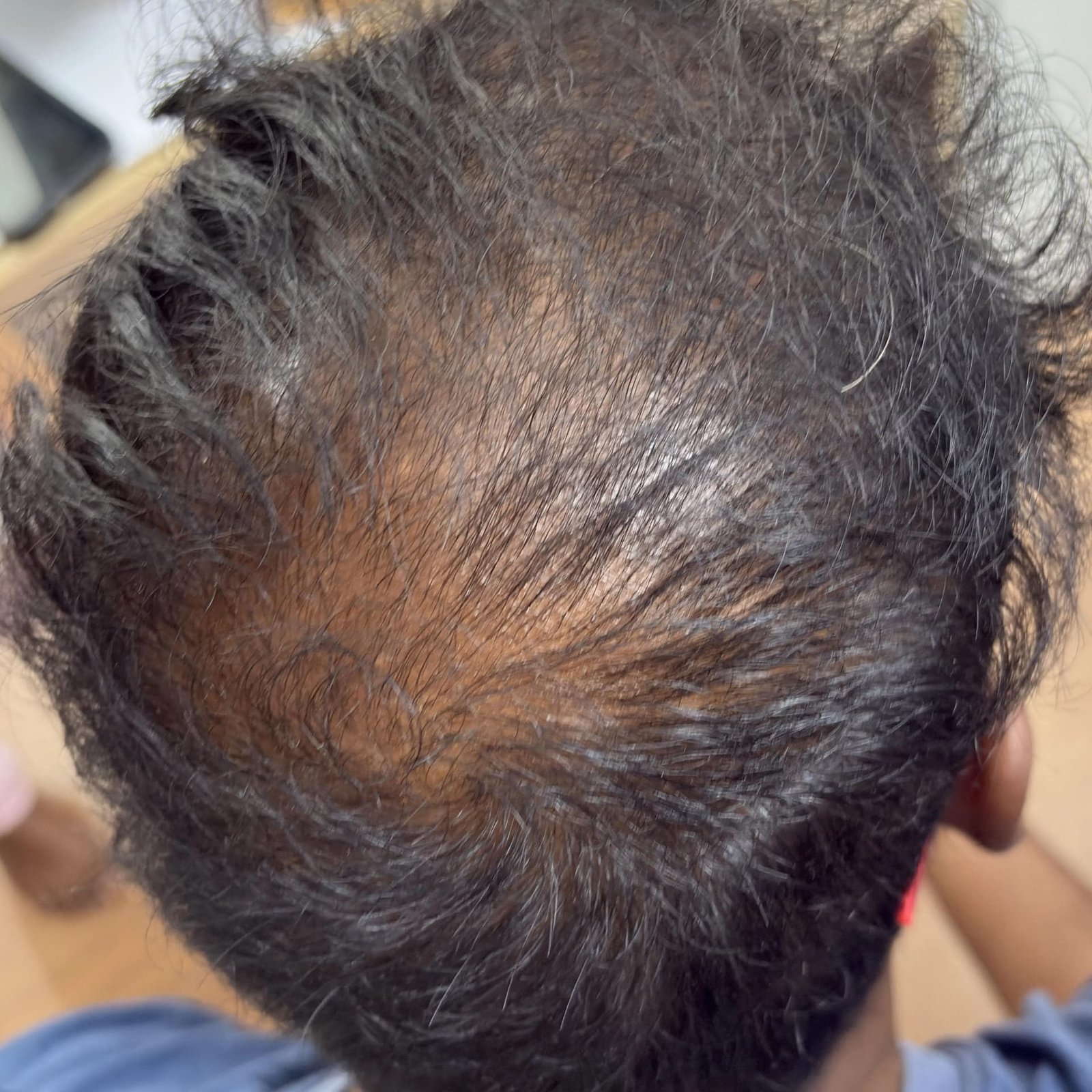 Hair Restoration Before