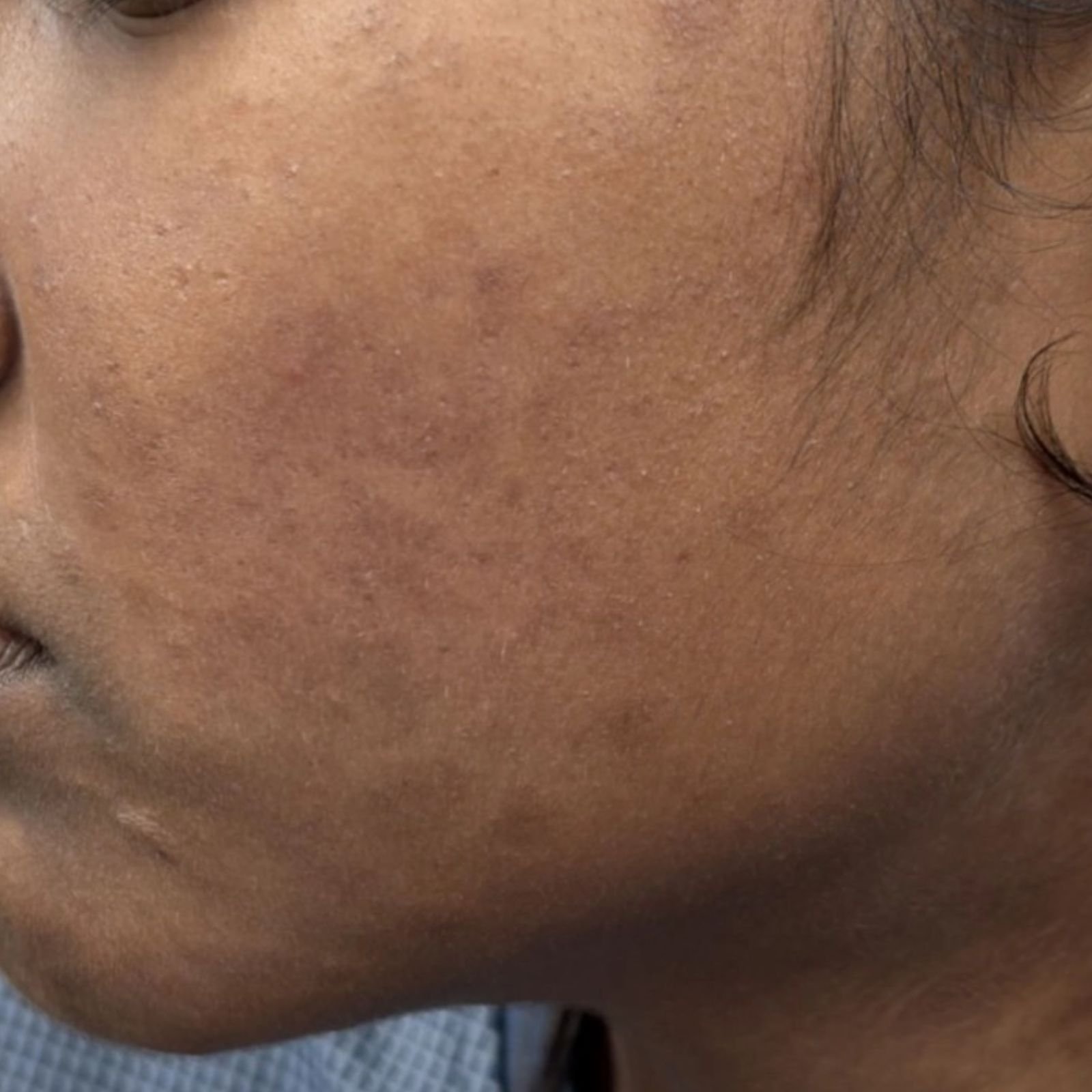 Active Acne Treatment After