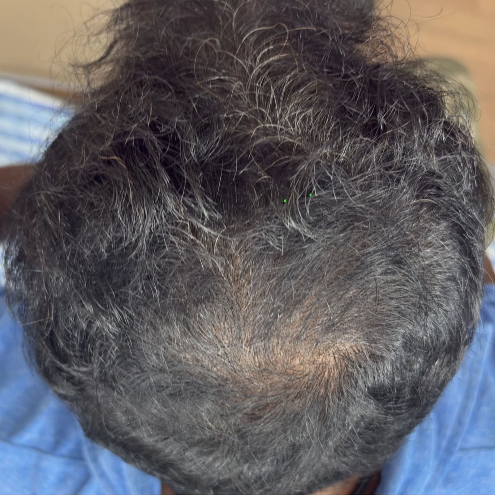 Hair Restoration After