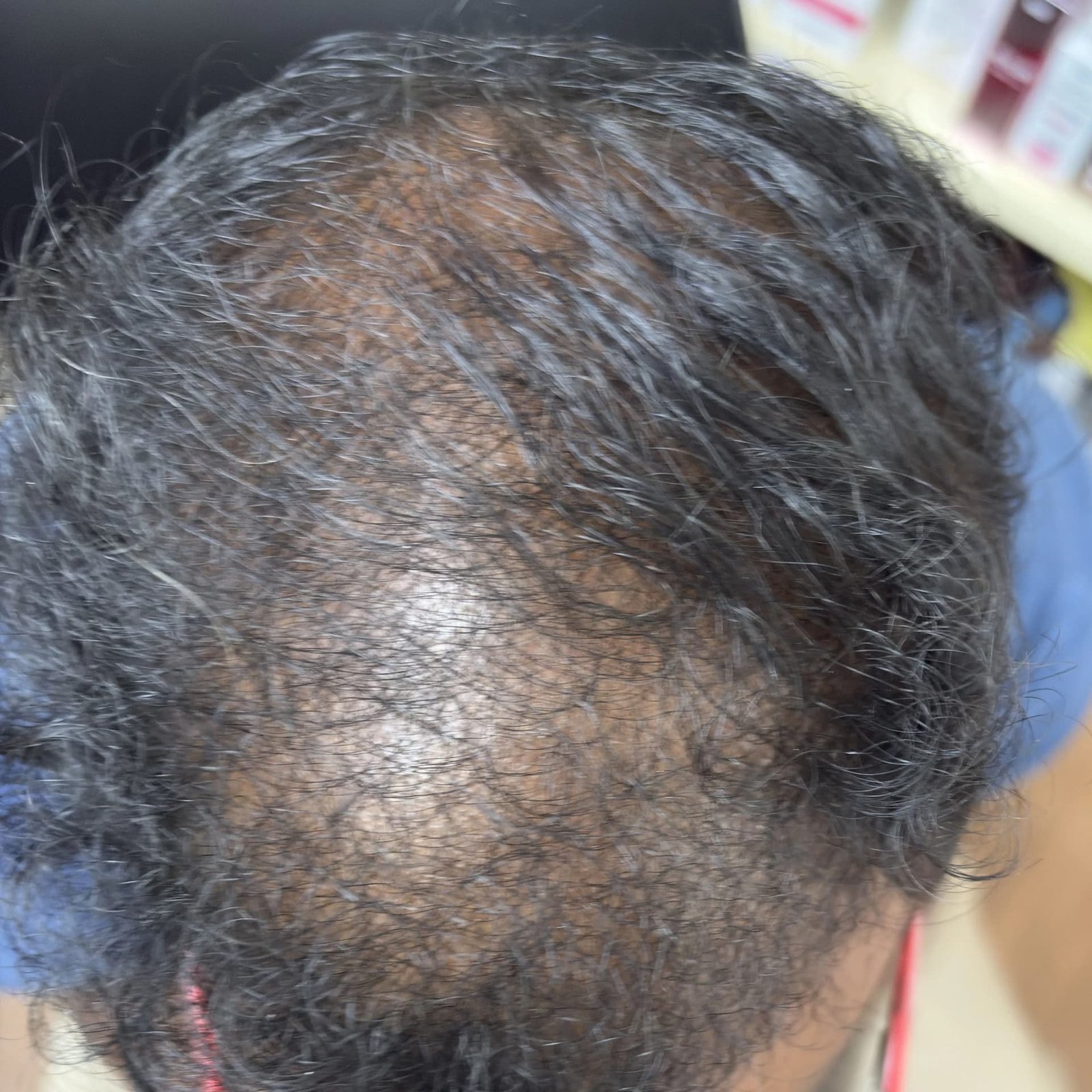 Hair Restoration Patient 2 Before