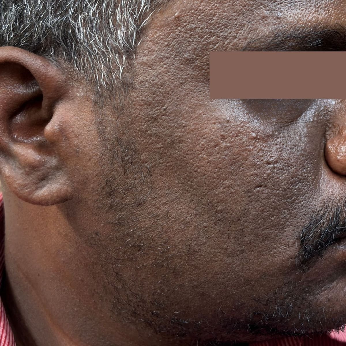 Pigmentation Patient 4 Before