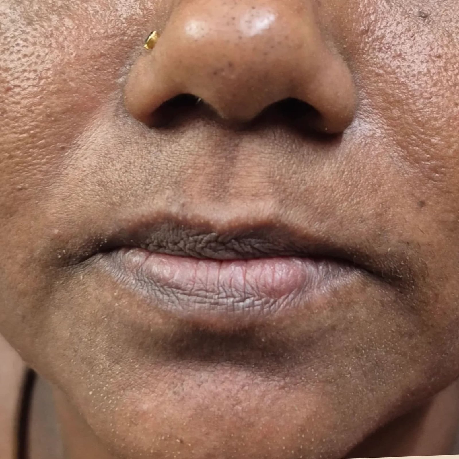 Laser Hair Removal After