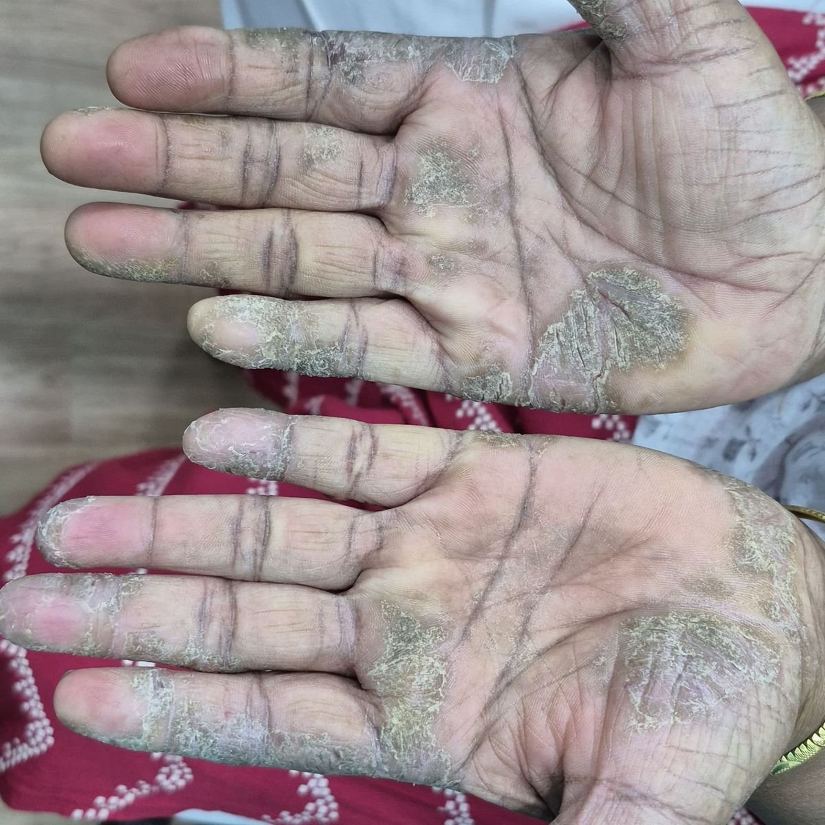 Psoriasis Before