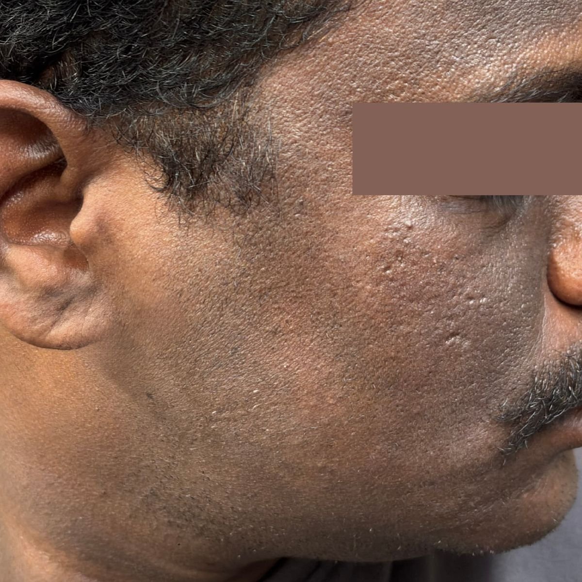 Pigmentation Patient 4 After