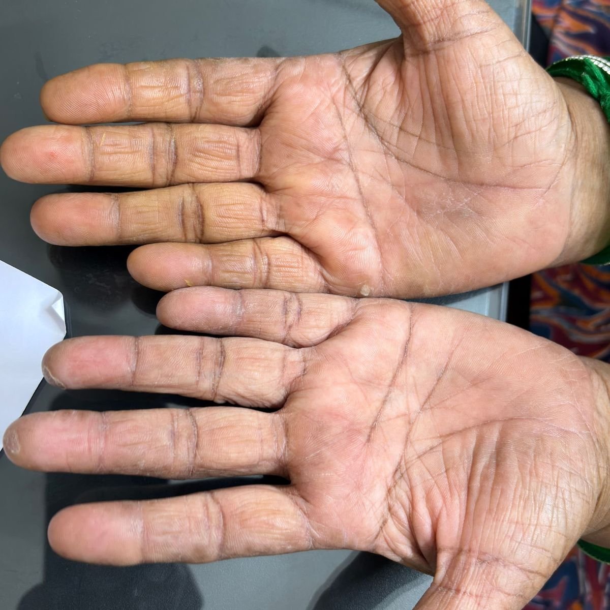 Psoriasis After