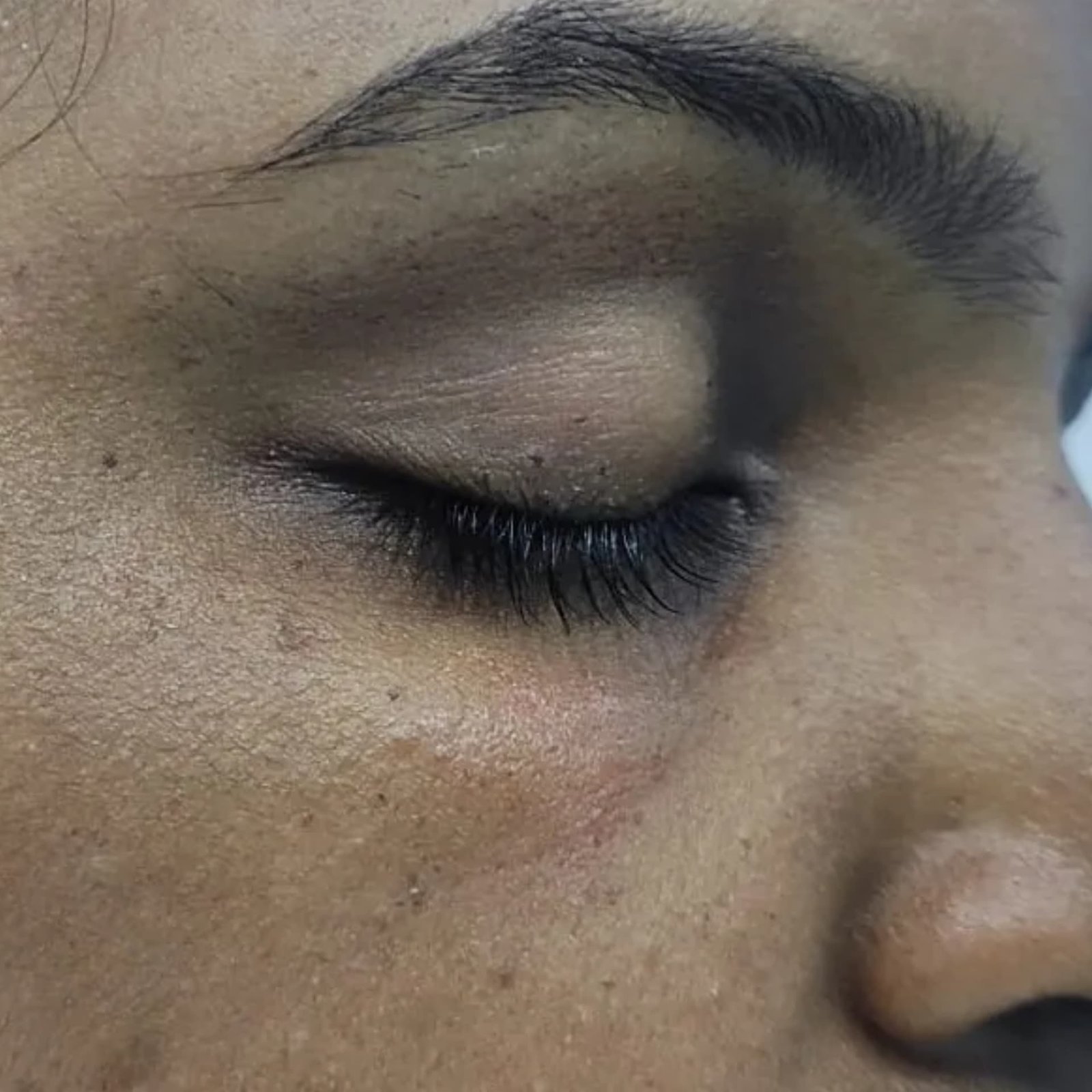 Mole Treatment After