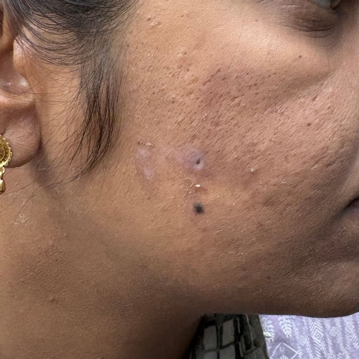 Cyst Excision After