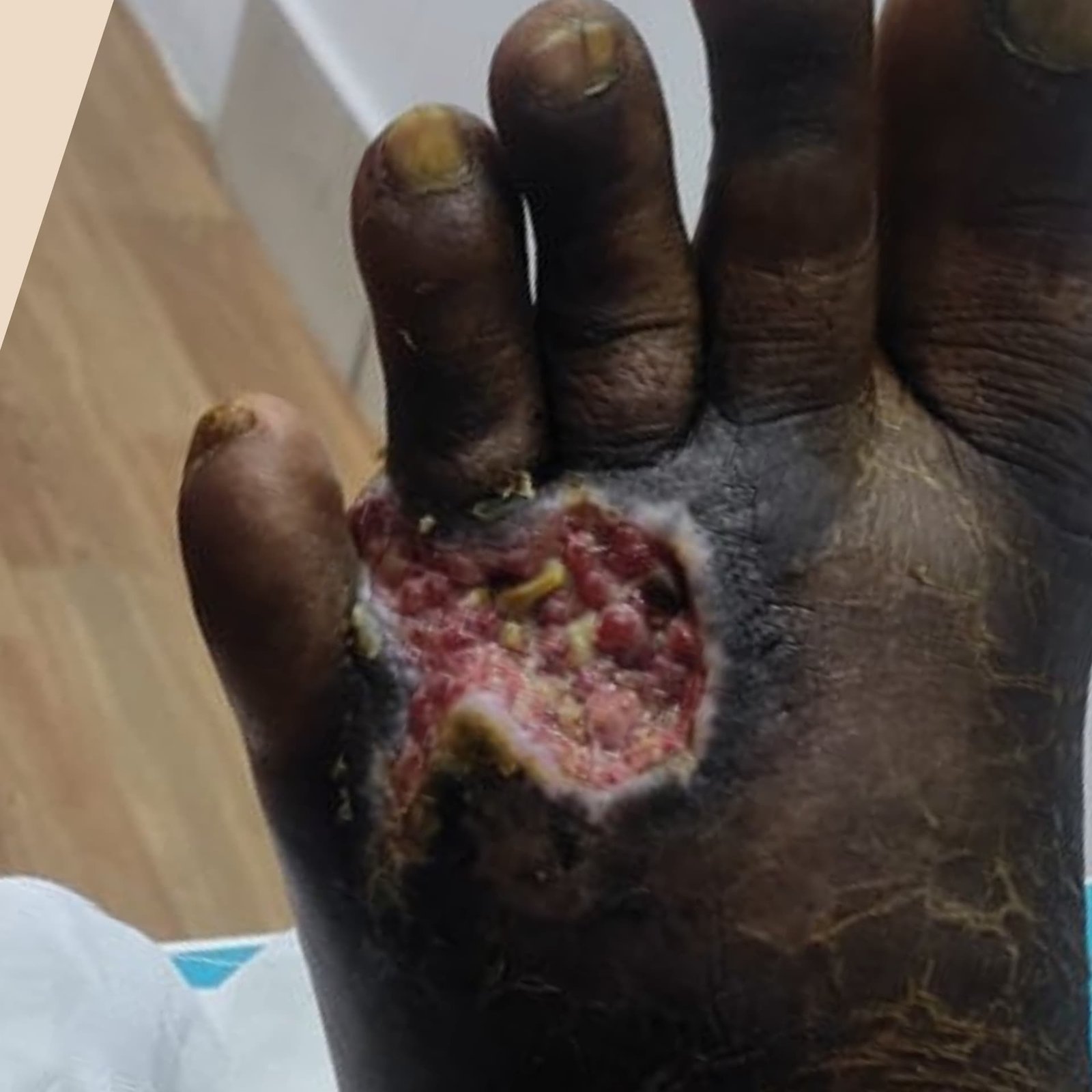 Chronic Ulcer Before