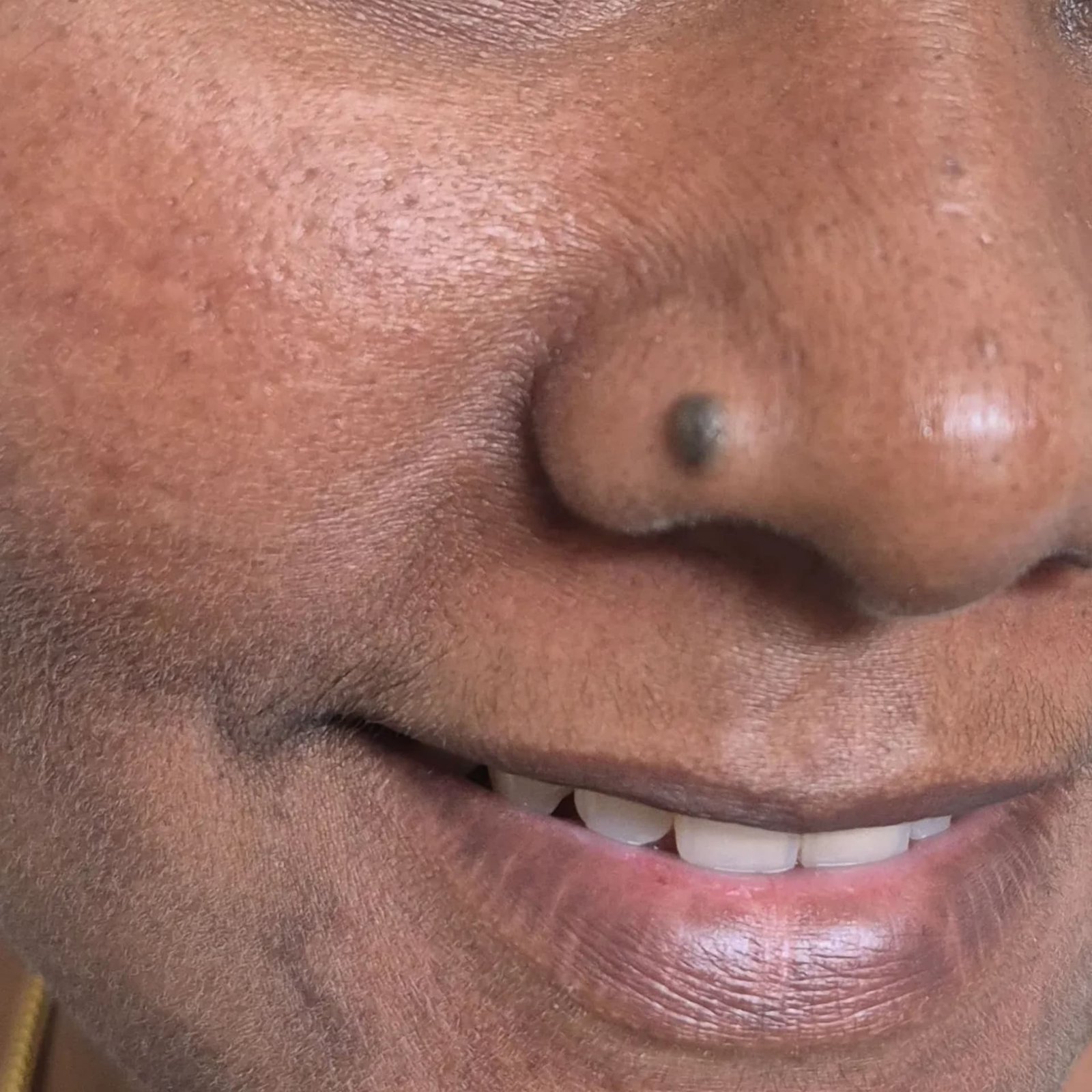 Complex Mole Treatment Before