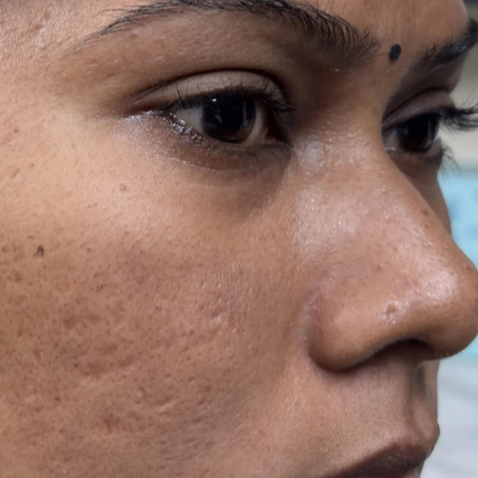 Complex Mole Treatment After