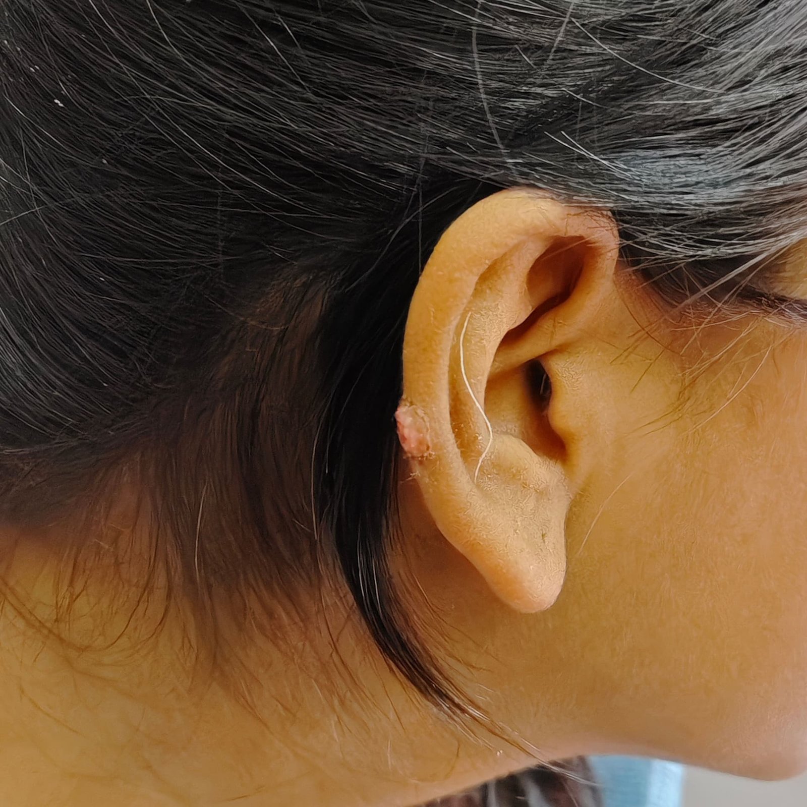 Keloid Treatment Before