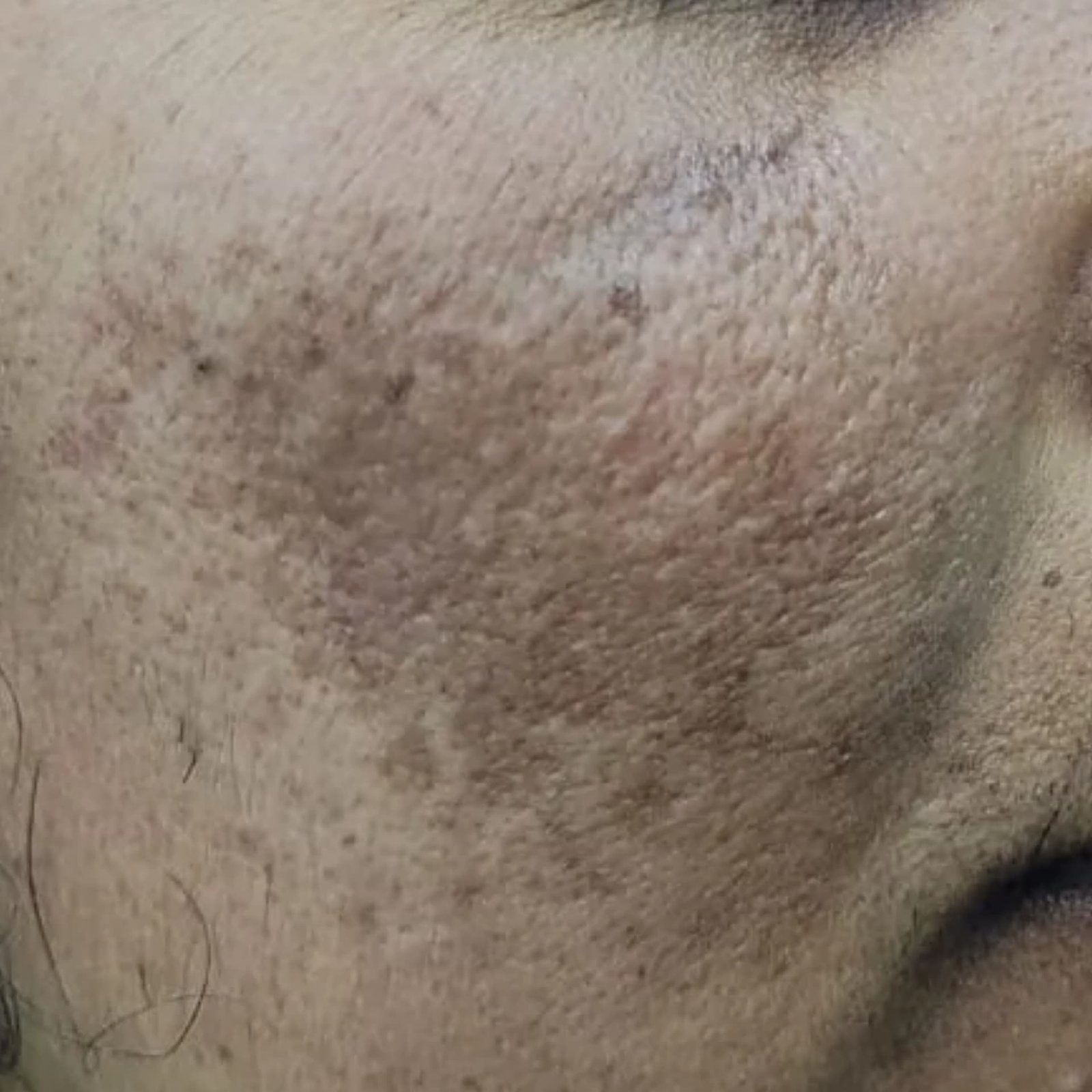 Melasma Treatment Patient 1 Before