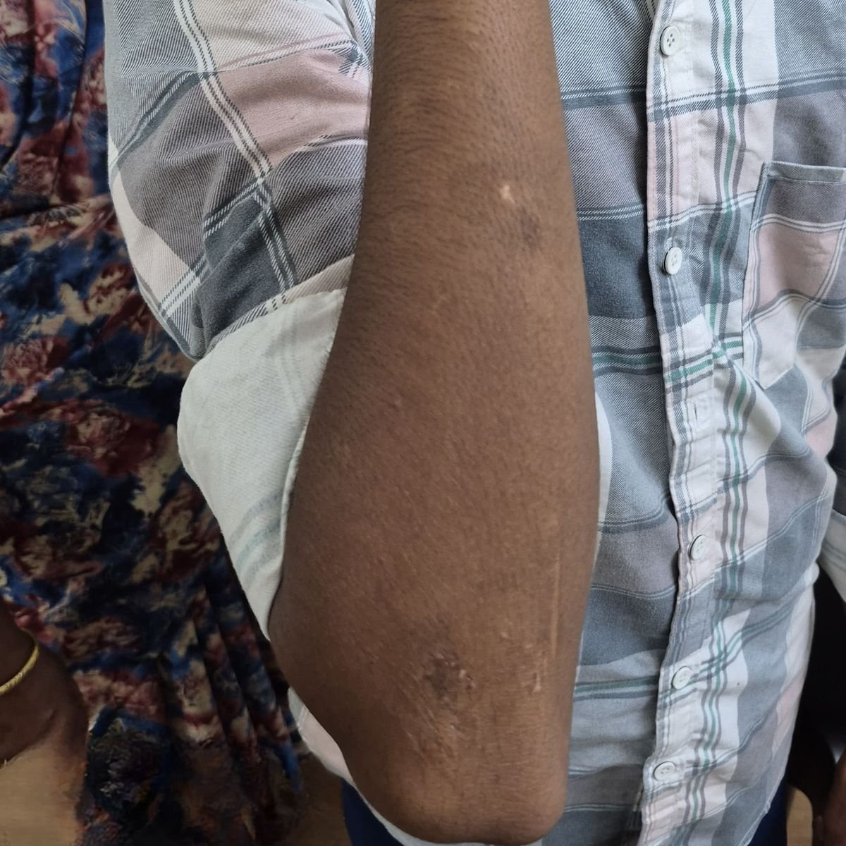 Vitiligo Patient 1 After