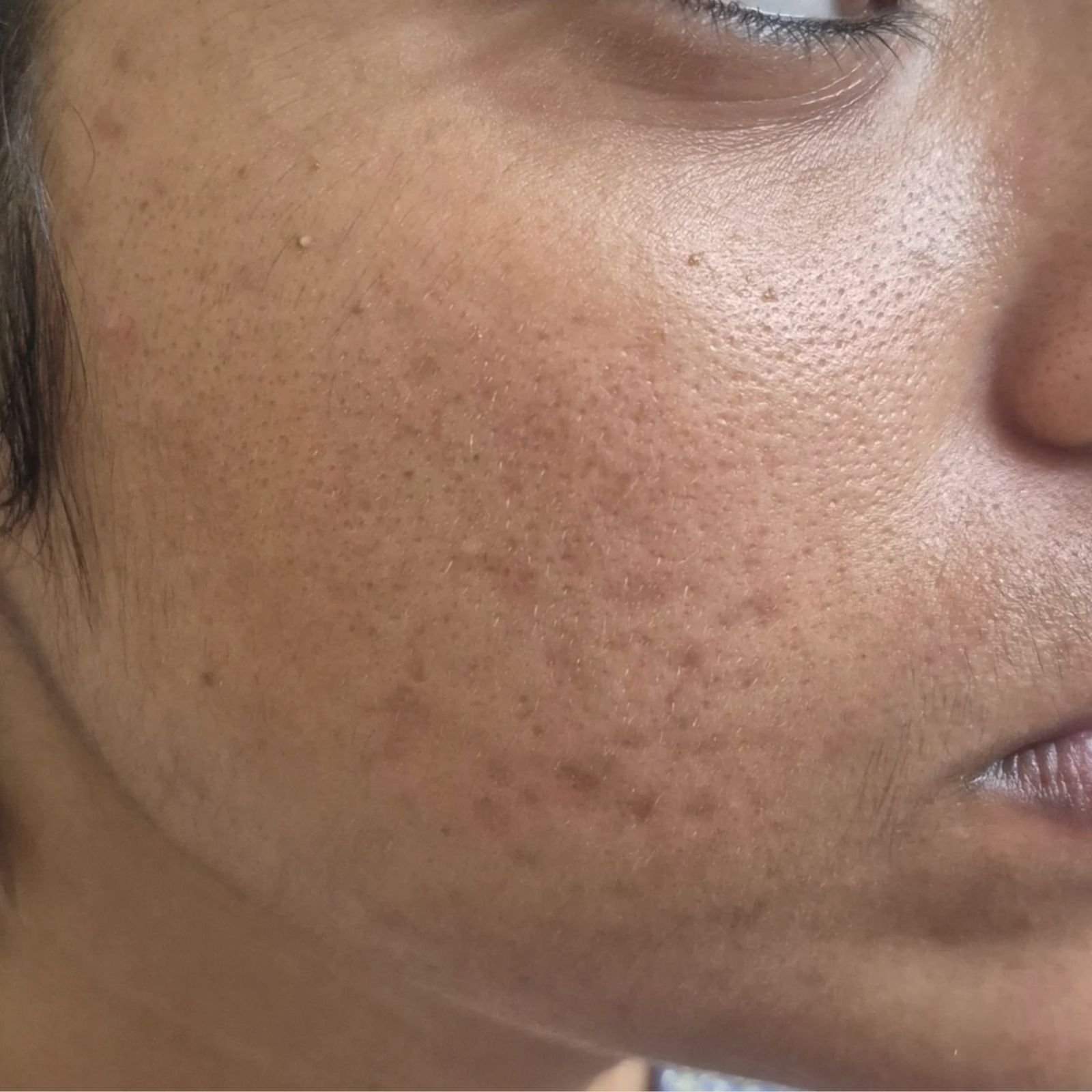 Inflammatory Acne After