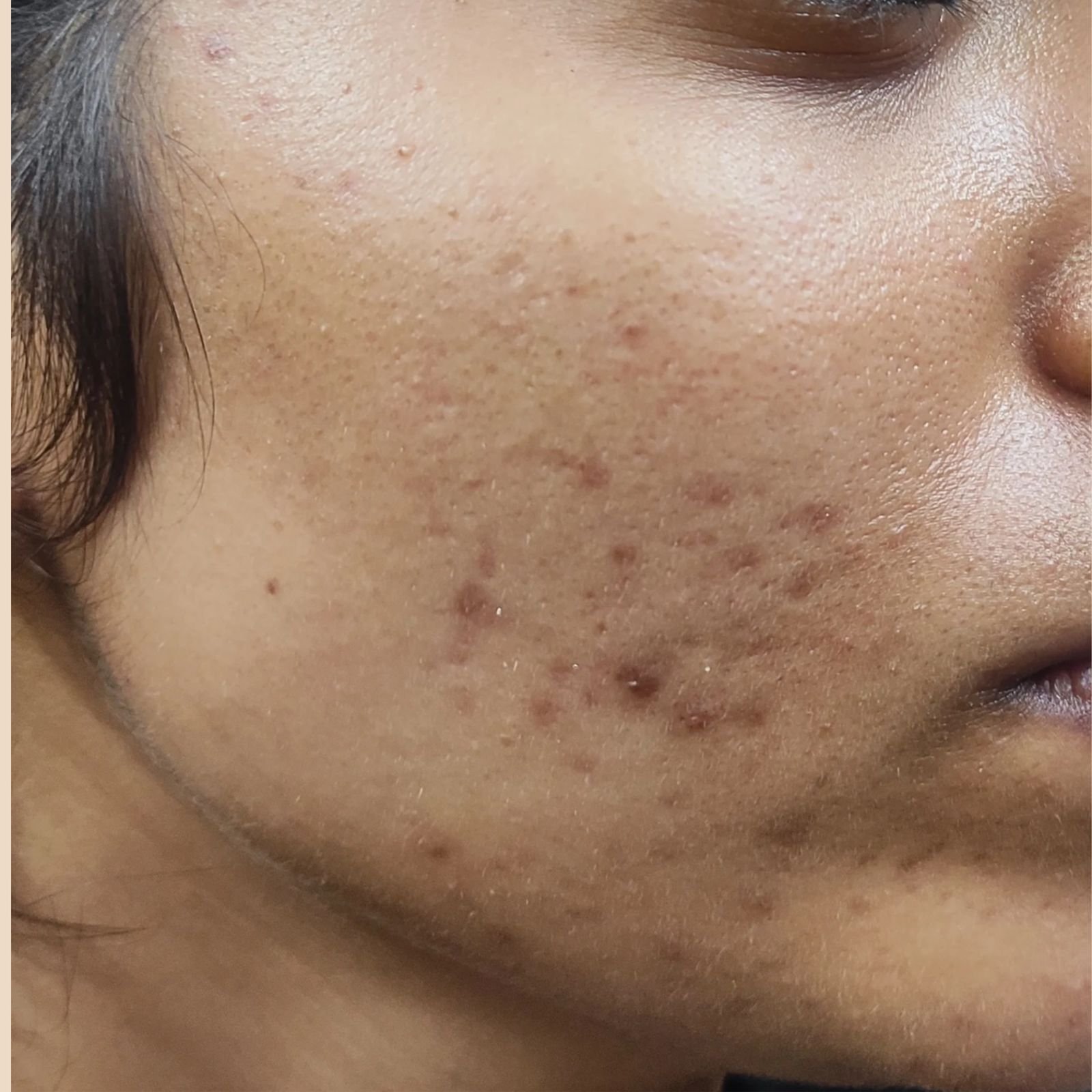 Inflammatory Acne Before