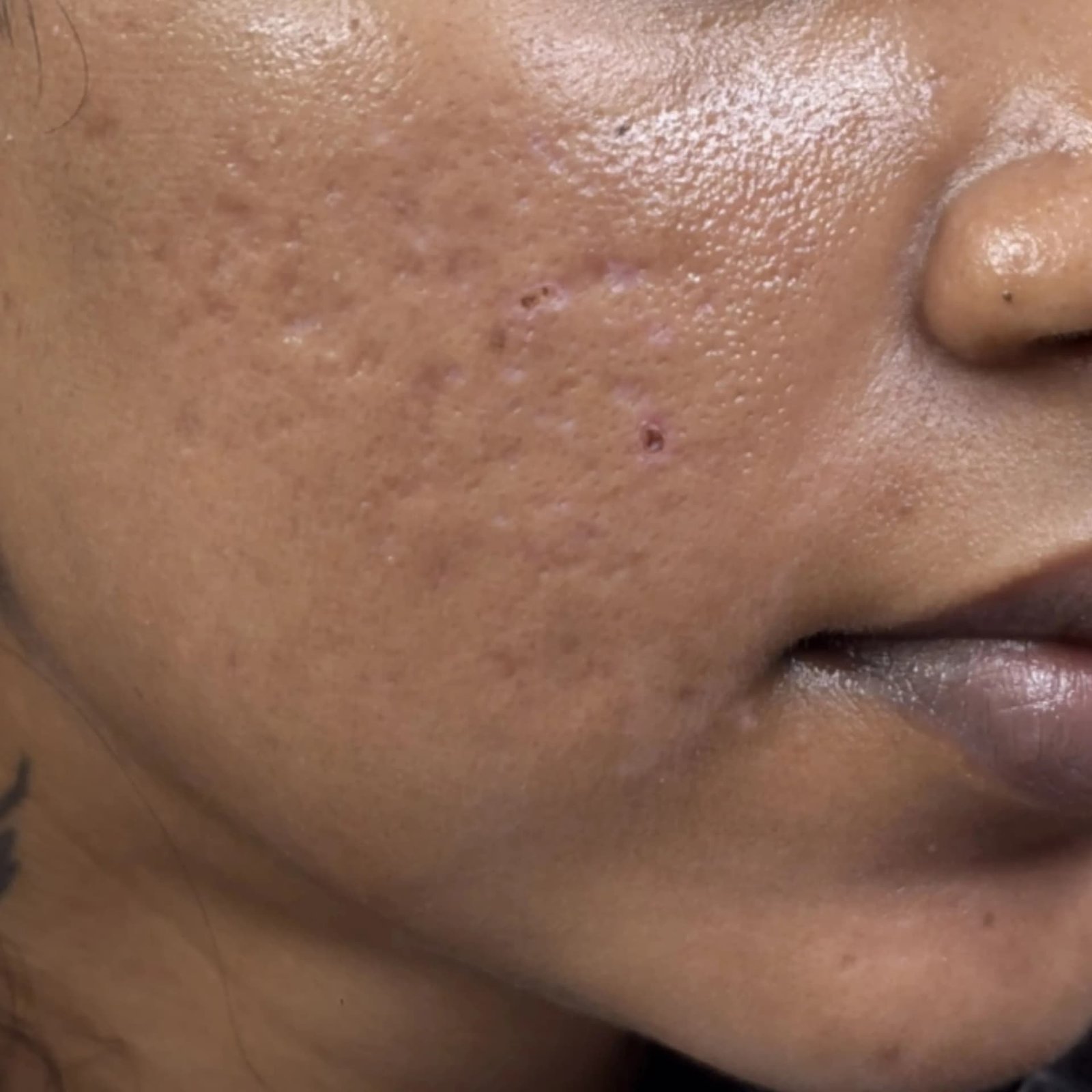 Acne Scar Patient 5 After