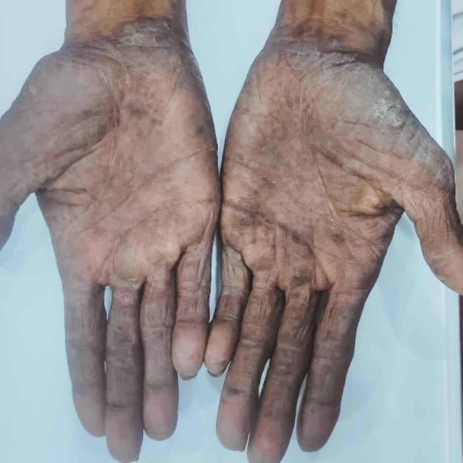 Psoriasis After