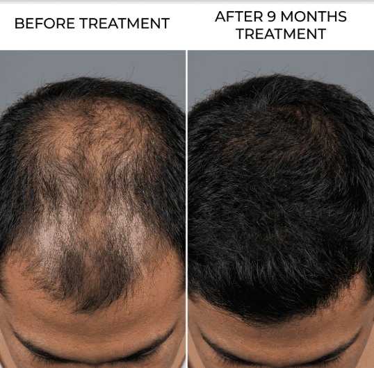 Clinical Hair Restoration Results