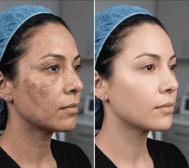 Clinical Pigmentation & Melasma Treatment Results