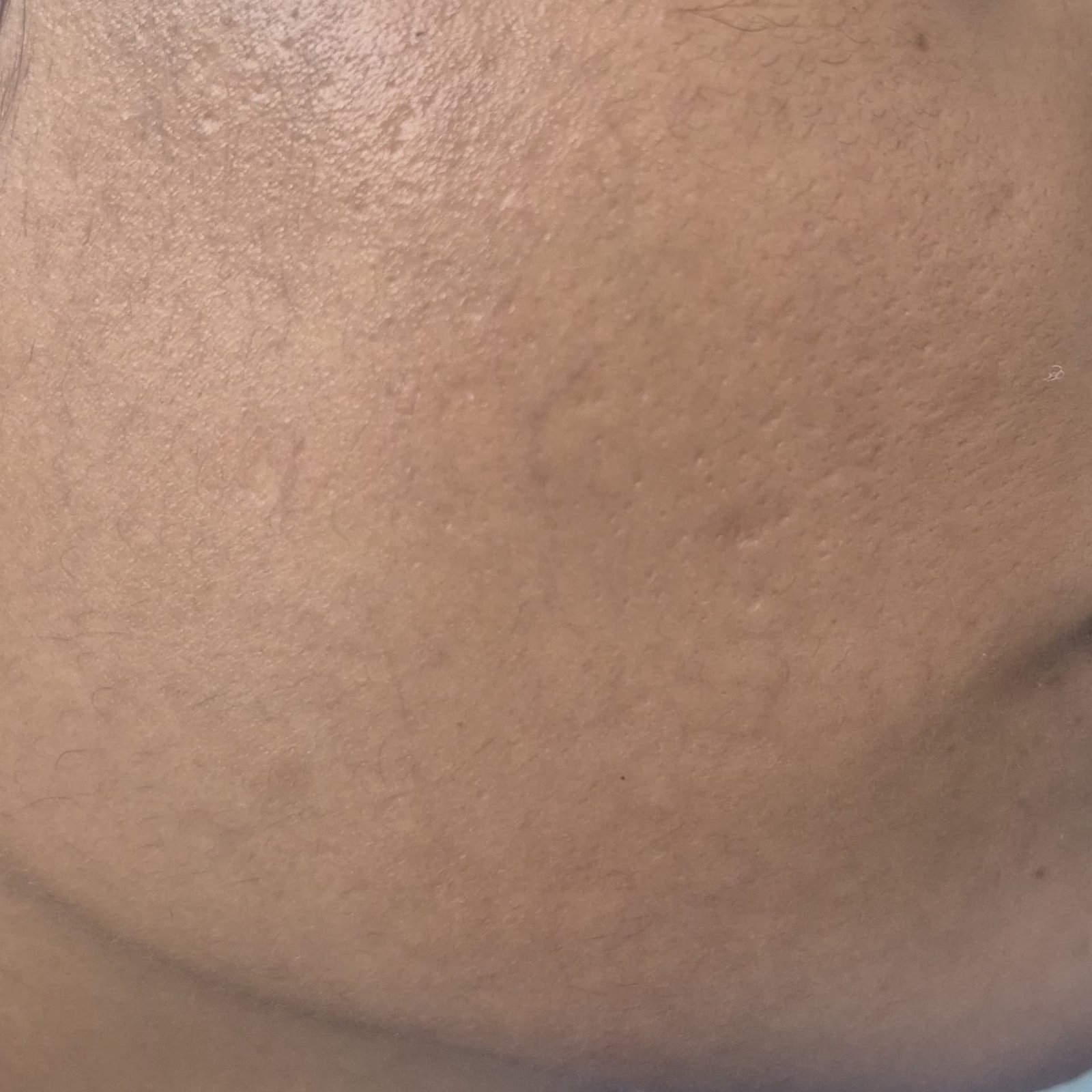 Laser Hair Removal After